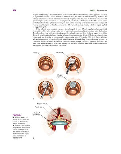Master Techniques in Otolaryngology - Head and Neck Surgery: Skull Base Surgery