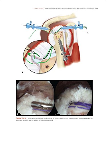 Shoulder Arthroscopy
