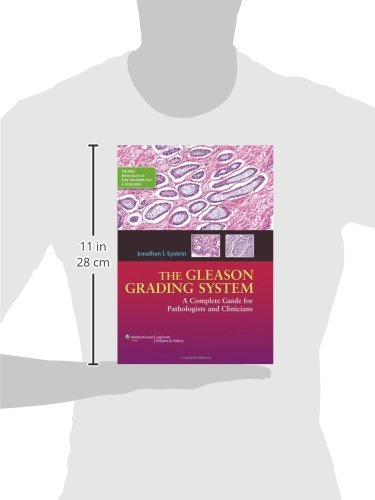 The Gleason Grading System: A Complete Guide for Pathologist and Clinicians