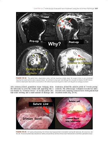 Shoulder Arthroscopy