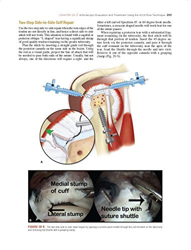Shoulder Arthroscopy