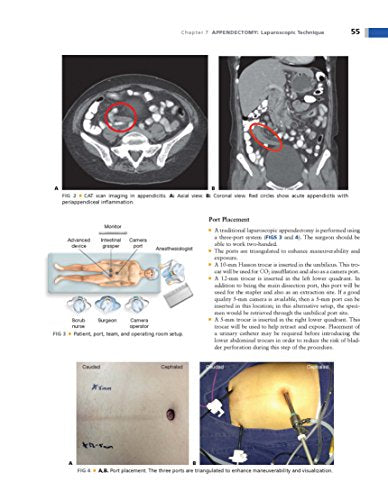 Operative Techniques in Colon and Rectal Surgery