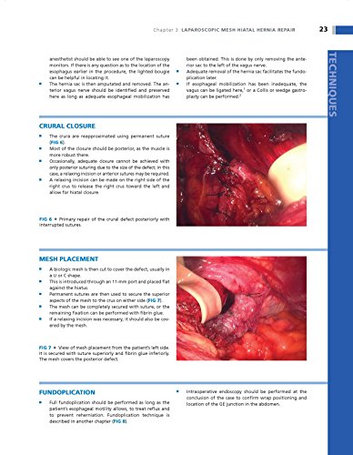 Operative Techniques in Foregut Surgery