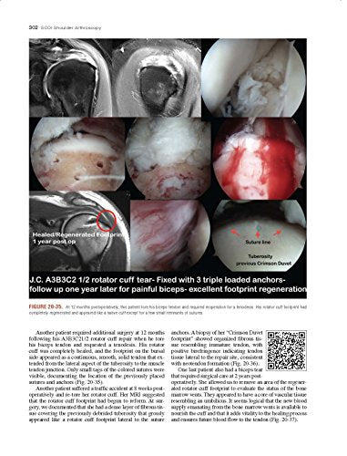 Shoulder Arthroscopy