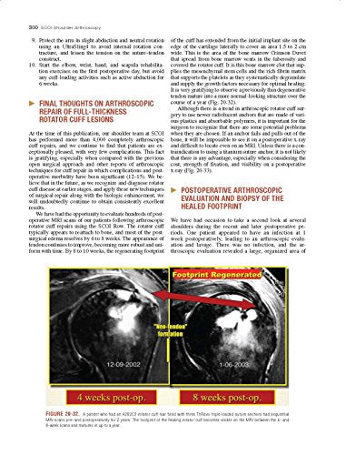 Shoulder Arthroscopy