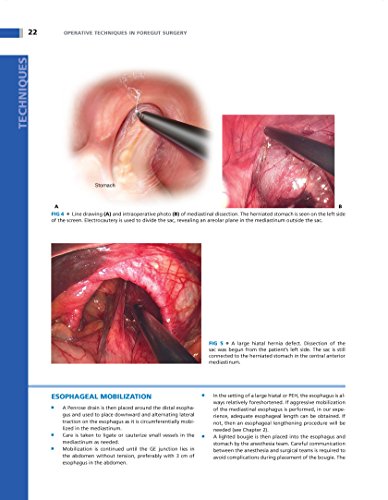 Operative Techniques in Foregut Surgery