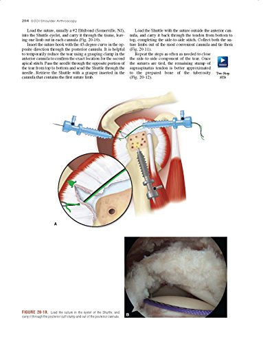 Shoulder Arthroscopy