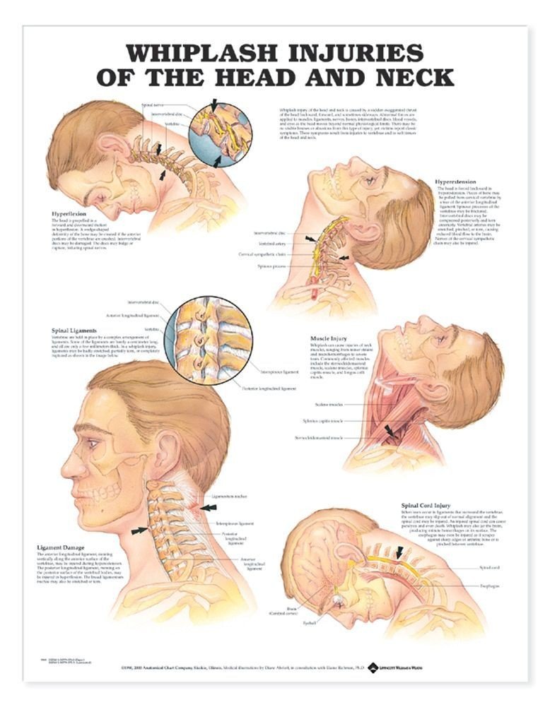 Whiplash Injuries of the Head and Neck Anatomical Chart