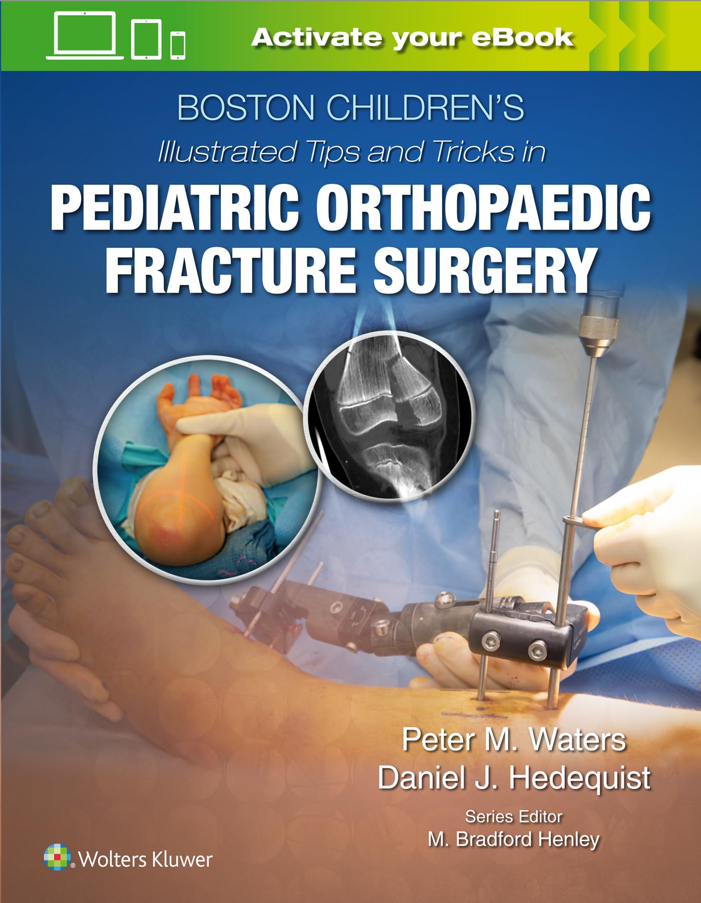 Boston Children’s Illustrated Tips and Tricks in Pediatric Orthopaedic Fracture Surgery