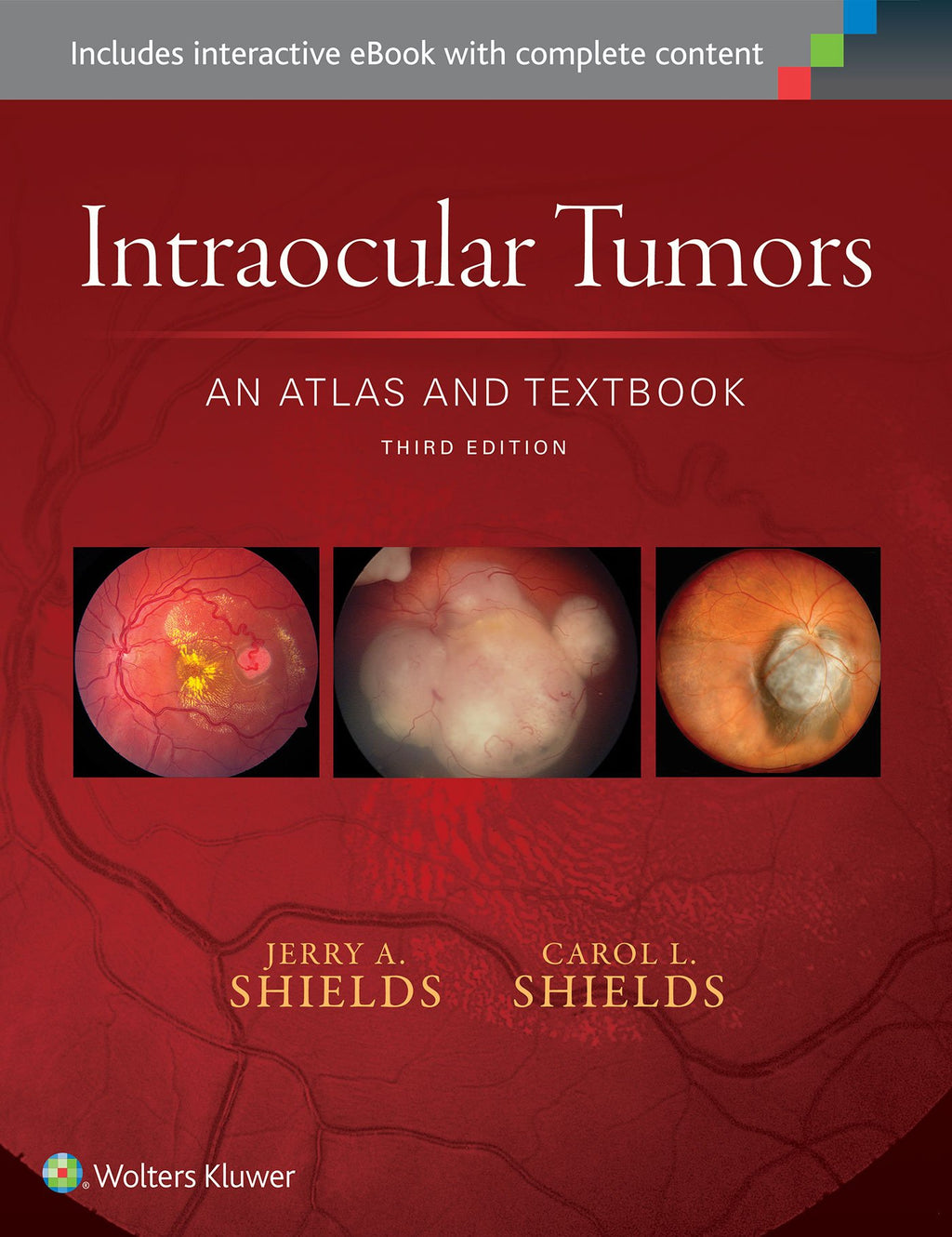 Intraocular Tumors: An Atlas and Textbook (Volume 1)