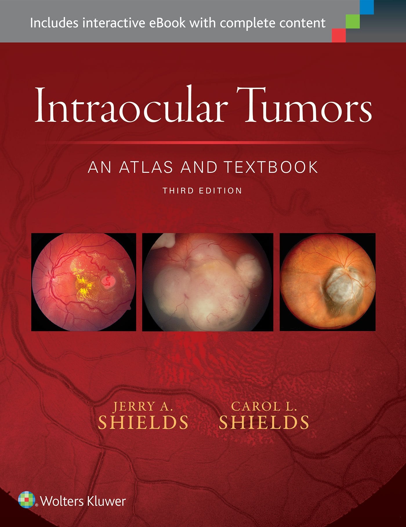 Intraocular Tumors: An Atlas and Textbook (Volume 1)