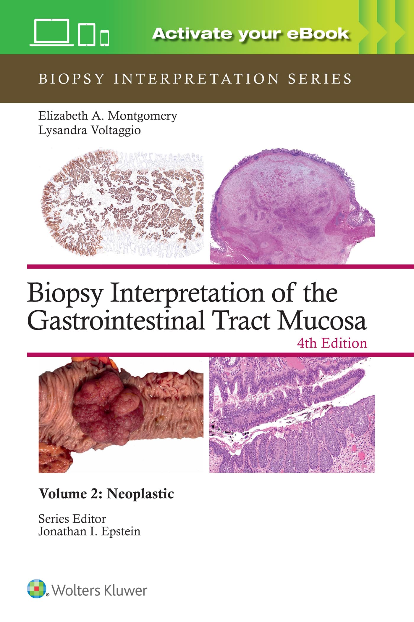 Biopsy Interpretation of the Gastrointestinal Tract Mucosa Volume 2: Neoplastic: Print + eBook with Multimedia (Volume 2)