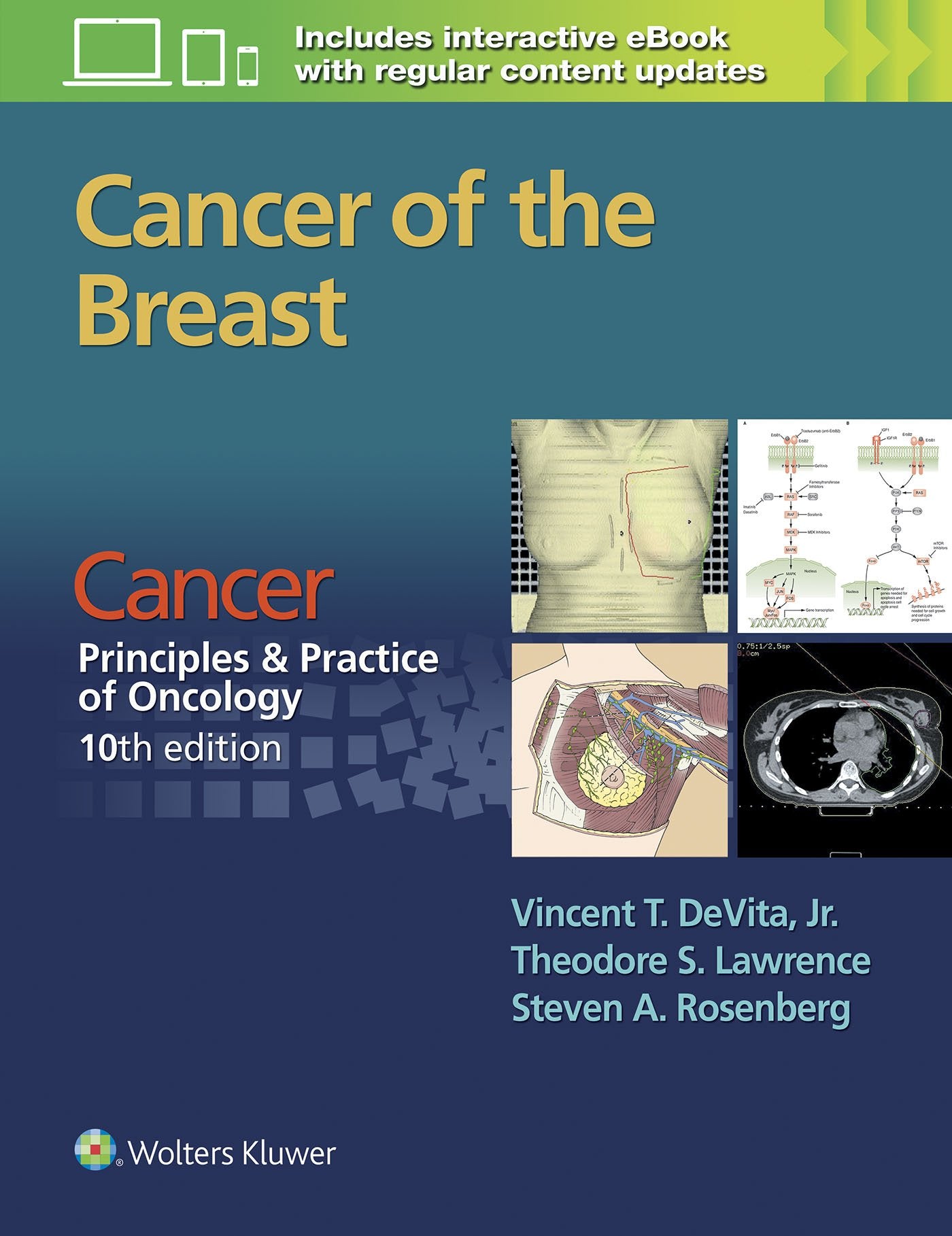 Cancer: Principles & Practice of Oncology. Cancer of the Breast